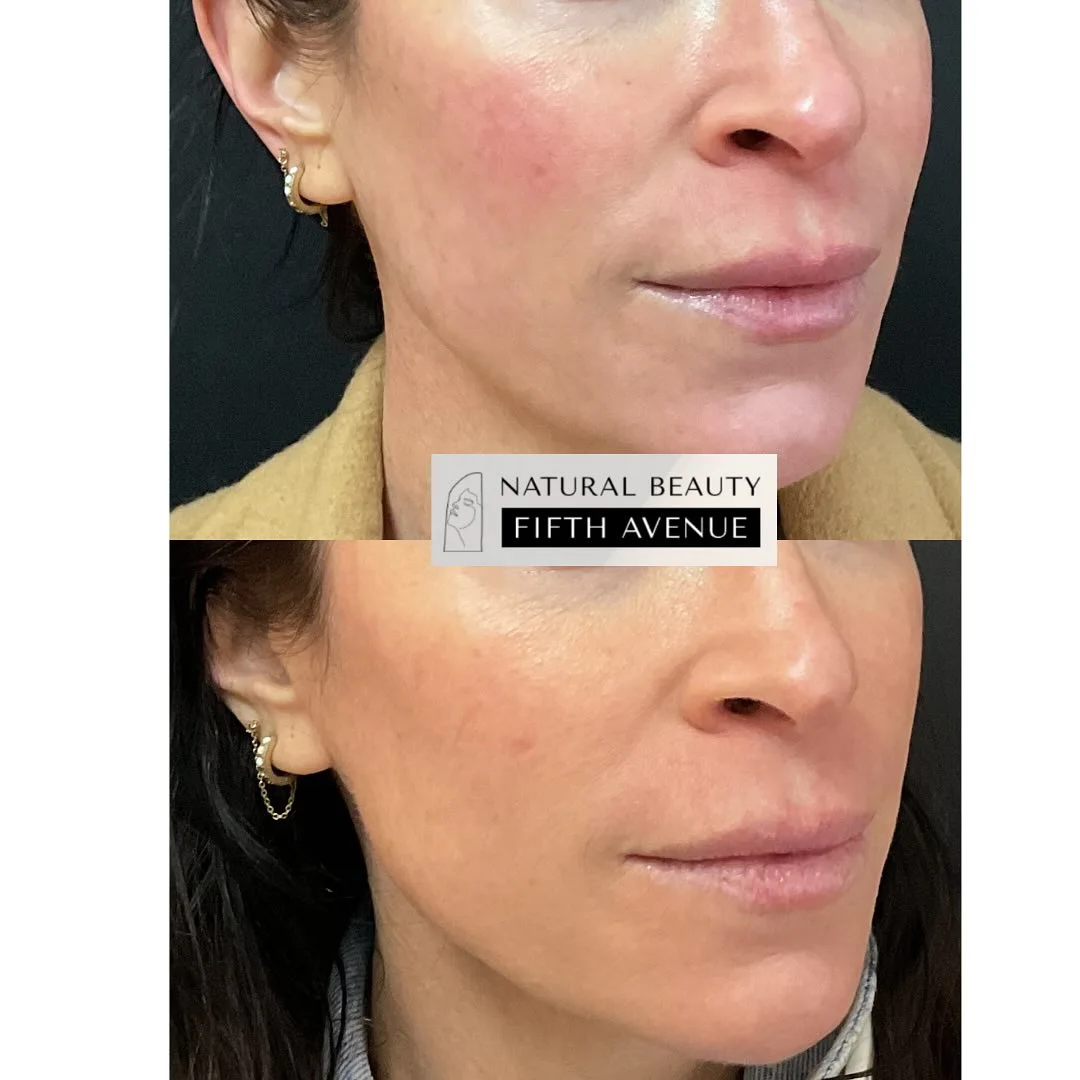 Before and after IPL treatment showing improved skin texture and reduced redness on patient's lower face and jawline